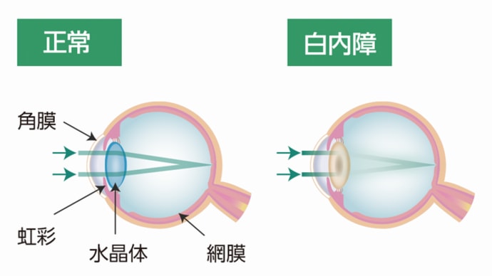 「高齢者の視機能低下」「眼科の定期受診」「早期の発見」