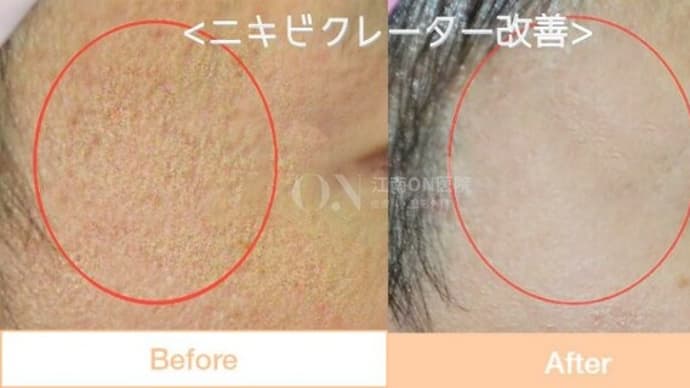 [お問い合わせ多数🔥]ニキビ跡・クレーター改善施術