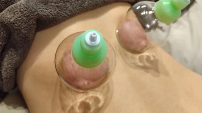 吸角施術