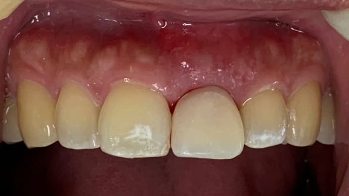 抜歯即時荷重インプラント、審美部位での本当の治療経過報告