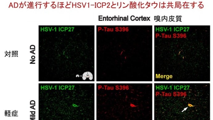 タウのリン酸化はヘルペスウイルス1型感染から神経細胞を保護している!!アルツハイマー病治療戦略へのインパクト