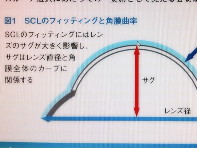 再チェック ソフトコンタクトレンズ処方で大切なフィッティング