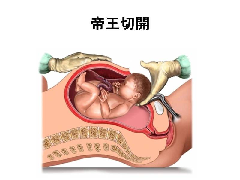 急速遂娩(きゅうそくすいべん)とは? - ある産婦人科医の 急速遂娩(きゅうそくすいべん)とは? - ある産婦人科医の
