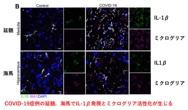 新型コロナウイルス感染症covid 19 最新エビデンスの紹介 9月10日 Neurology 興味を持った 脳神経内科 論文