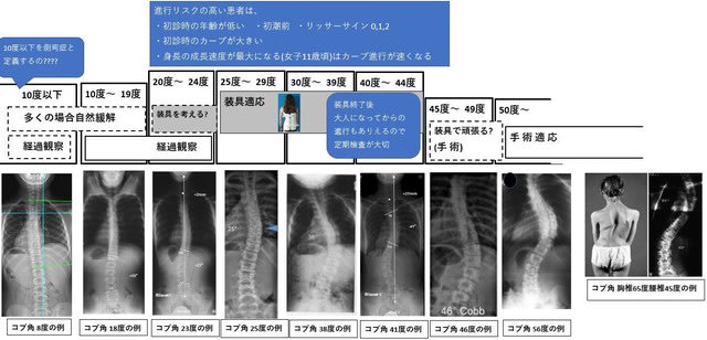 大塚整体 側湾症 木型 （東京にある側湾症専門 | 大塚整体治療院）