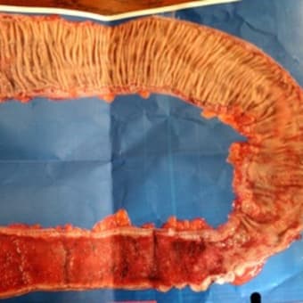 閲覧注意 摘出した大腸の写真 かおぽんと潰瘍性大腸炎の上手なつきあいかた