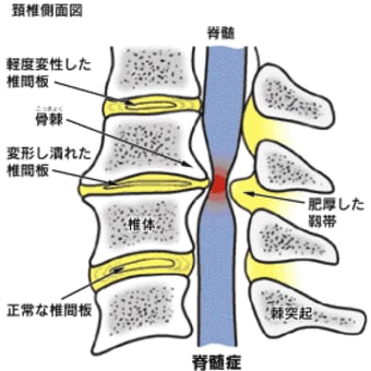 腰部脊柱管狭窄症