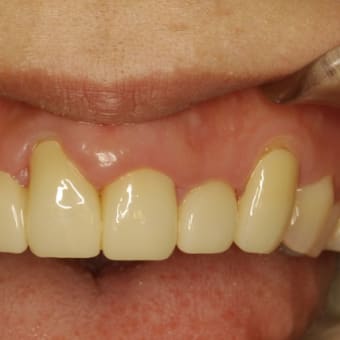 前歯の差し歯の長さに満足されていますか？　歯の長さを短くする審美歯科治療のご紹介