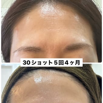 新メニュー「 M式ヒト幹細胞培養上清液トリプルショット」