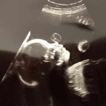 妊婦健診6回目（25w5d）経膣エコー