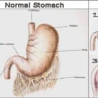胃捻転について