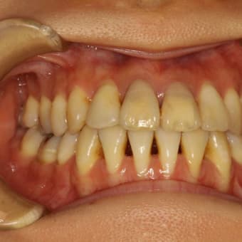 重度の歯周病でなかなか治らない方は歯周内科で細菌除去治療がお勧めです。