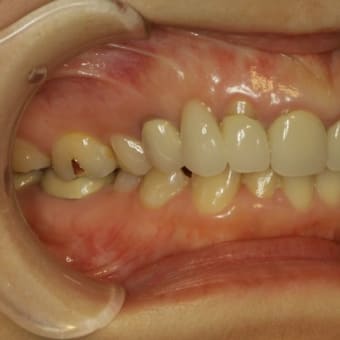 要注意です。歯を抜いた後にブリッジ治療をする場合、歯茎が下がって歯が長くなってしまう事があります。お勧めの審美歯科治療