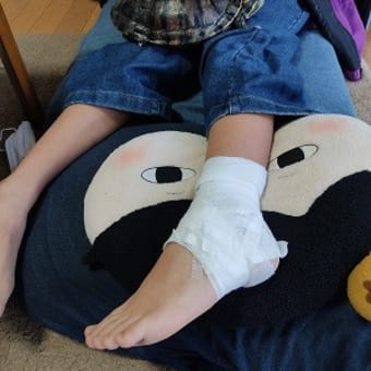 次女ちゃん、捻挫