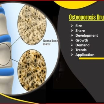 Osteoporosis Drugs Market Trends, Drivers, Growth Opportunities