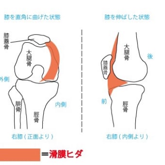 画像一覧 滑膜ヒダ症 タナ障害 の悲惨な高校生