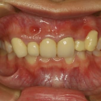 八重歯の審美歯科治療に歯茎の再生治療が有効です。