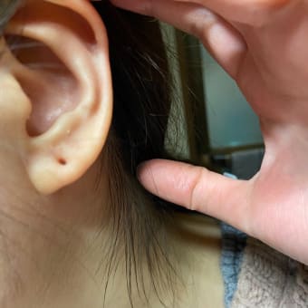 ピアッシング３年１か月過ぎ　ついに！？