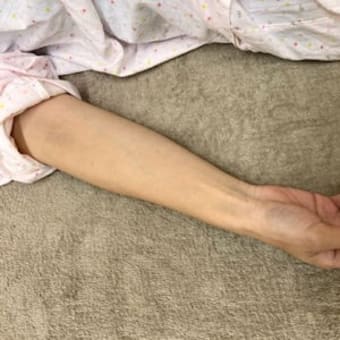 右手の痺れ（仮称・痺鍼）：臨床実践塾と忘年会（11月28日）のお知らせ