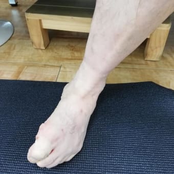 内出血の存在と理由は、ケガの種類と場所によって、まったく違います！ケガを正確に判断するため、内出血の真実を知ってください。
