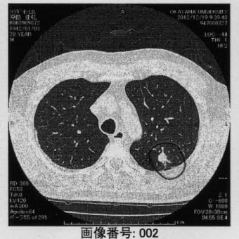 肺の影は、何だろう？