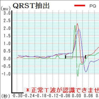 【激レア】　心房細動が収まる瞬間の心電図