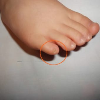 足の小指の爪