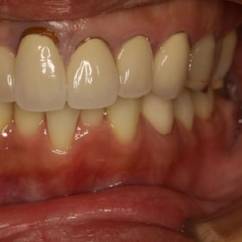 前歯の差し歯の長さが左右でちがう場合の治療方法