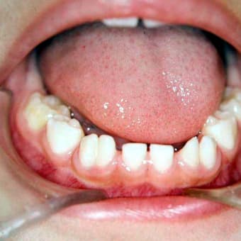 乳歯の数～癒合歯（ゆごうし）について