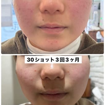 新メニュー「 M式ヒト幹細胞培養上清液トリプルショット」