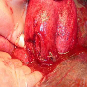 分娩による子宮穿孔・膣穿孔