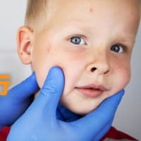 全米で麻疹が流行、CDCはわずか2週間で患者数が100％急増と報告 | Facts Matter