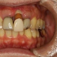 歯茎が壊死してしまった場合の歯茎の再生治療