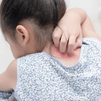 子どもの湿疹を防ぐには? この記事を読むと、それが分かります