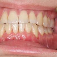 歯茎の厚みを厚くして歯茎の退縮を少なくする歯茎の移植術