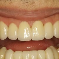 歯周病が進行して、歯茎が下がってしまったり、歯が揺れてしまっている方のための審美歯科治療のご紹介です。