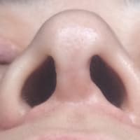 鼻中隔延長、小鼻縮小6ヶ月半