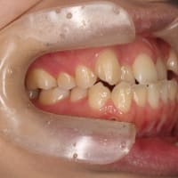 マウスピースで歯列矯正した、抜歯をしないで反対咬合を治す。