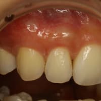 歯茎が下がってしまった場合は歯ぐきの再生治療で歯の形も変わります．