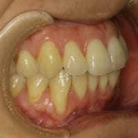 歯茎の再生治療例　