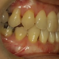矯正治療の後に下の前歯の歯茎が下がってしまうことがよくあります。