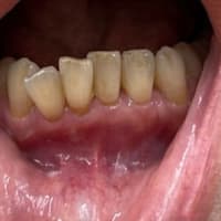 歯肉炎の治療：これからのセミナーの準備（７）