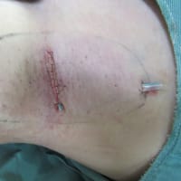名古屋栄の「にしやま形成外科皮フ科クリニック」で腋臭、わきがの手術