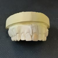 当院で金属を使わない　白い被せ物　ＣＡＤ／ＣＡＭ冠(ハイブリットセラミック)が　前歯を含む　ほぼすべての歯に保険で治療する事が可能になりました