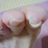 巻き爪矯正