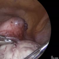 子宮筋腫核出術への私のこだわり３ - Myoma Pseudocapsule（MPC）を温存して筋腫だけを核出する -