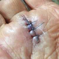 右手バネ指の手術