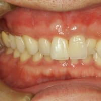 長い差し歯の治療　〜ピンクの歯茎のついたセラミックにならない治療法〜