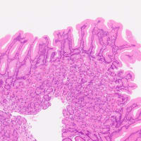 胃腺窩上皮型腺腫(gastric foveolar-type adenoma)と深切り切片(deeper sections) vs.連続切片(serial sections)。ラズベリー様ポリープ