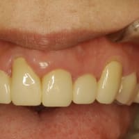 差し歯の長さは満足してますか？ 長い差し歯の治療法のご紹介です。